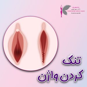 تنگ کردن واژن - دکتر سرور ایوبی