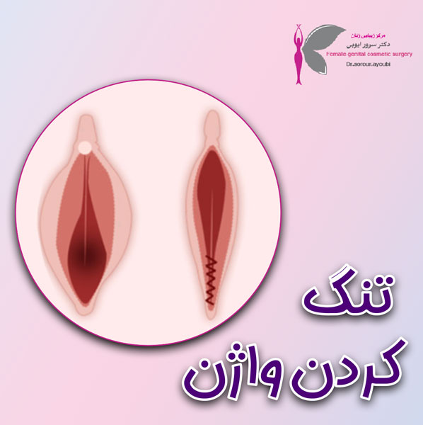 تنگ کردن واژن - دکتر سرور ایوبی