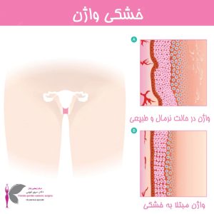 خشکی واژن - دکتر سرور ایوبی