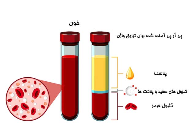 پی آر پی واژن - دکتر سرور ایوبی