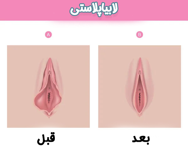 لابیاپلاستی - دکتر سرور ایوبی