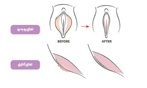 لابیاپلاستی - دکتر سرور ایوبی