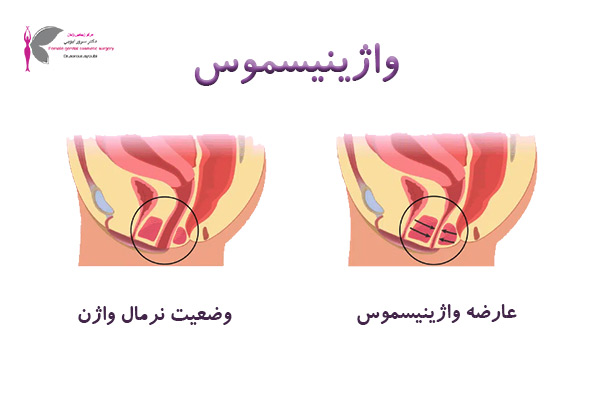 واژینیسموس - دکتر سرور ایوبی در اهواز