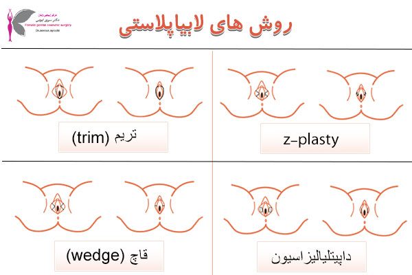 لابیاپلاستی در اهواز - دکتر سرور ایوبی